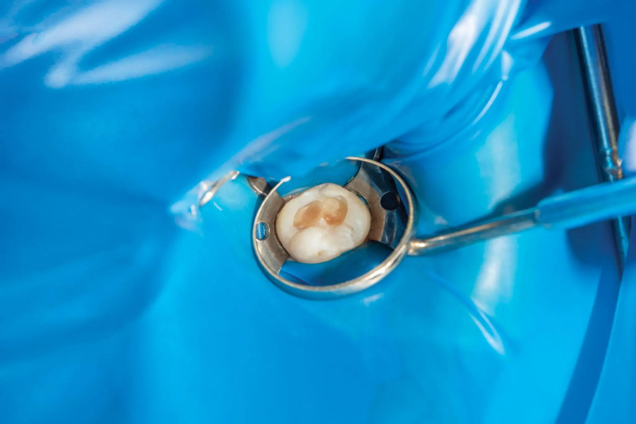 Tratamiento de restauración dental en Del Carmen Odontología